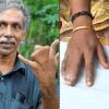 Family in Kerala has webbed fingers, refuses surgery calling it curse from god