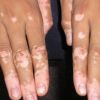Pune woman with vitiligo denied massage therapy, spa apologises