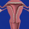 4 uterus transplants from live donors done in Texas; 3 fail