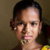 10-yr-old may be first female with tree-man syndrome in Bangladesh