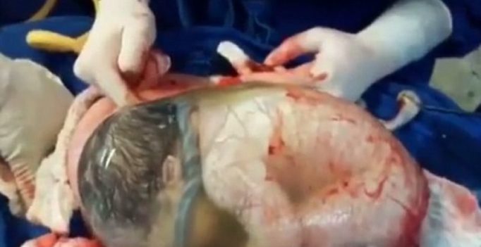 Video: Rare moment of baby born inside fully intact amniotic sack