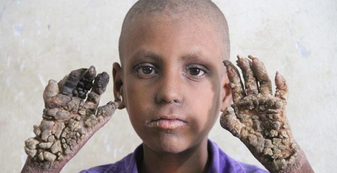 Bangladesh boy with abnormal condition has hands and feet that look like trees