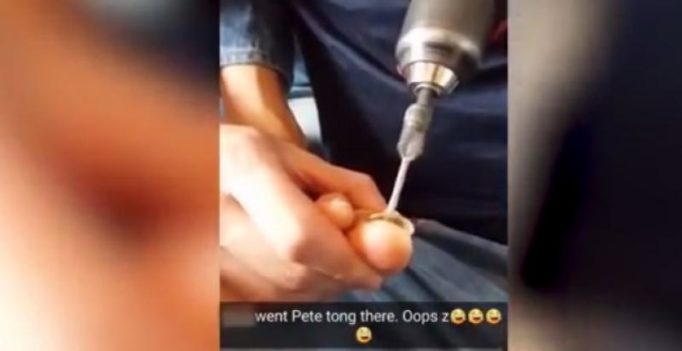 Watch: Scotsman drills his damaged toe nail with a power drill