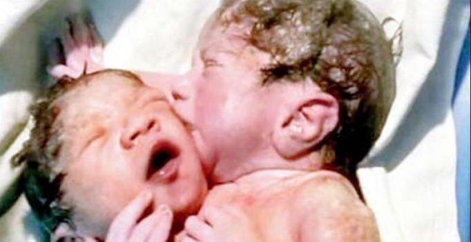 Conjoined twins might not undergo surgery due to fear over survival