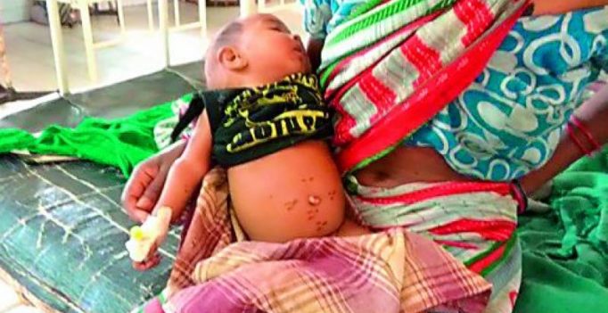 Odisha: Infant branded with hot iron to ‘cure’ stomach ailments