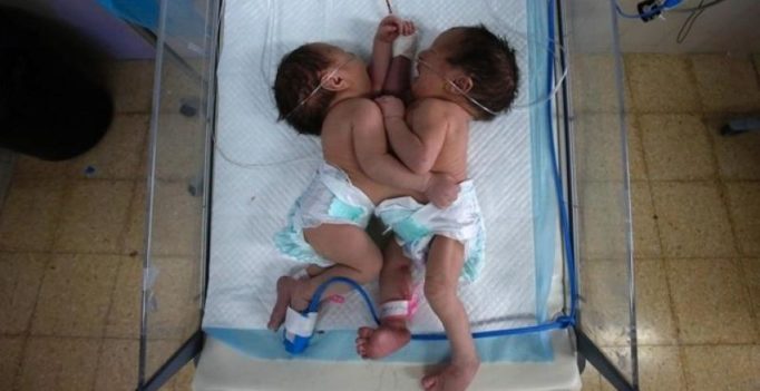 Conjoined twin sisters born in West Bank share one heart