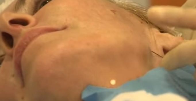 Women are using needle and thread for weird facelift promising immediate results