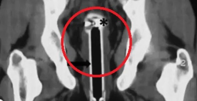 Man rushed to hospital with 6-inch-long shower head stuck in his anus